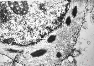 F,14y. | piloidal astrocytoma